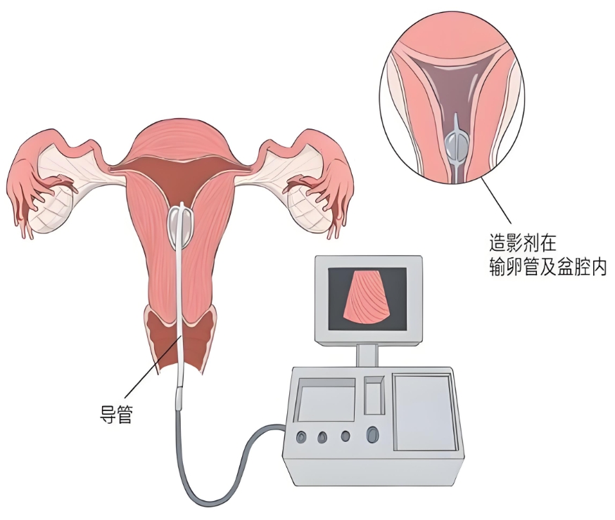输卵管造影