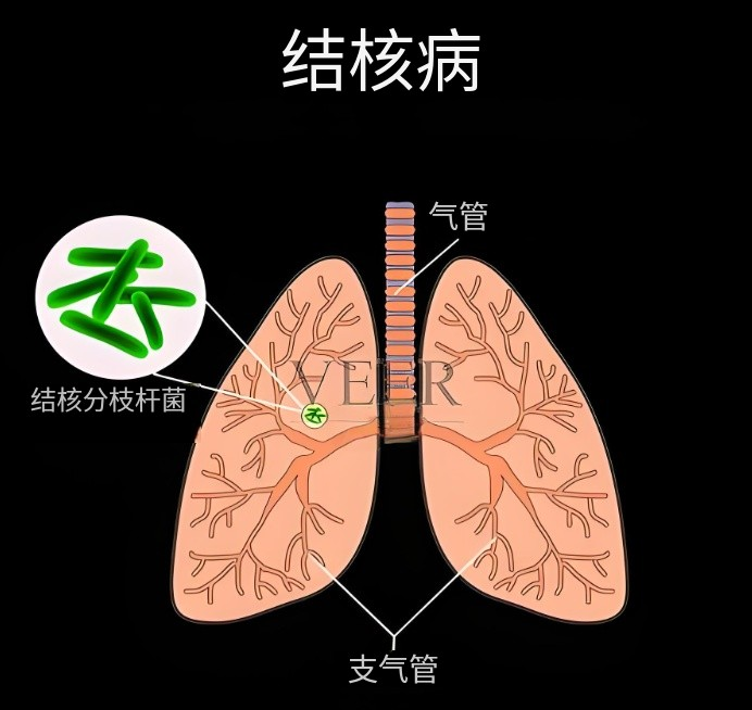肺结核病菌