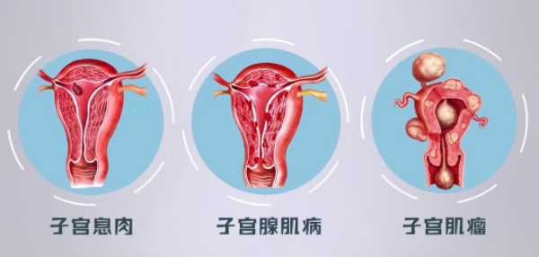 子宫问题