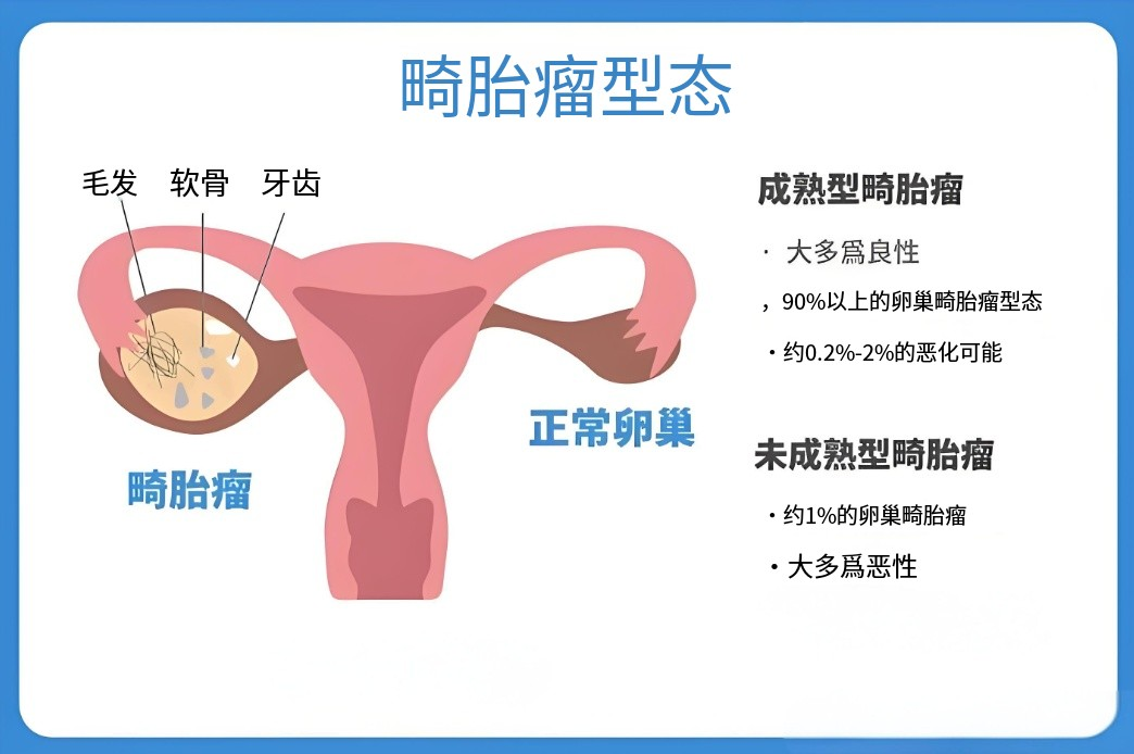 卵巢畸胎瘤