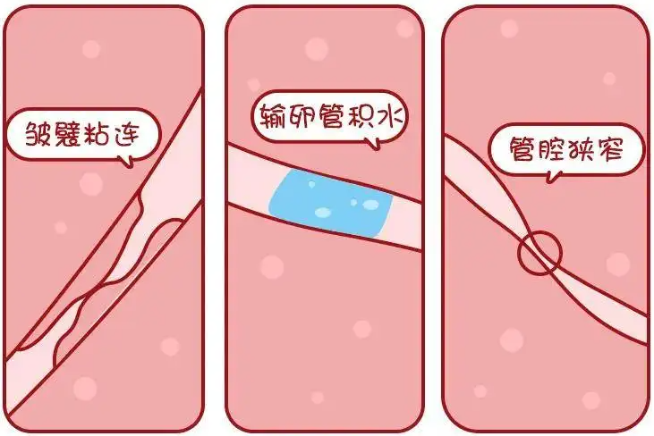 女性输卵管堵塞