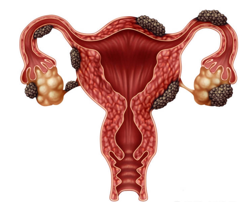 子宫内膜异位症