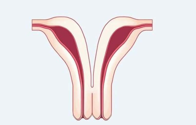 子宫畸形