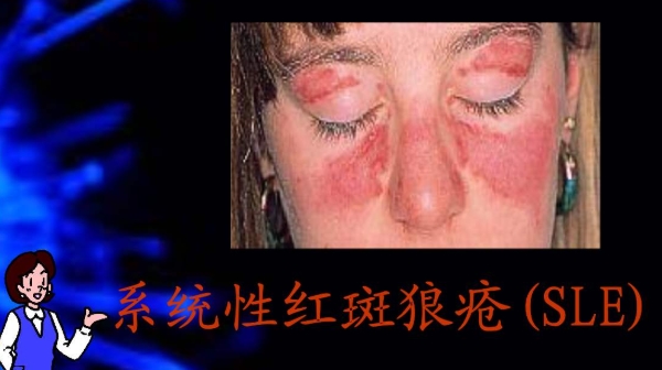 红斑狼疮