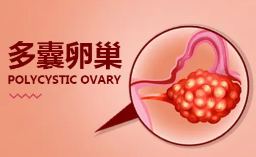 多囊卵巢