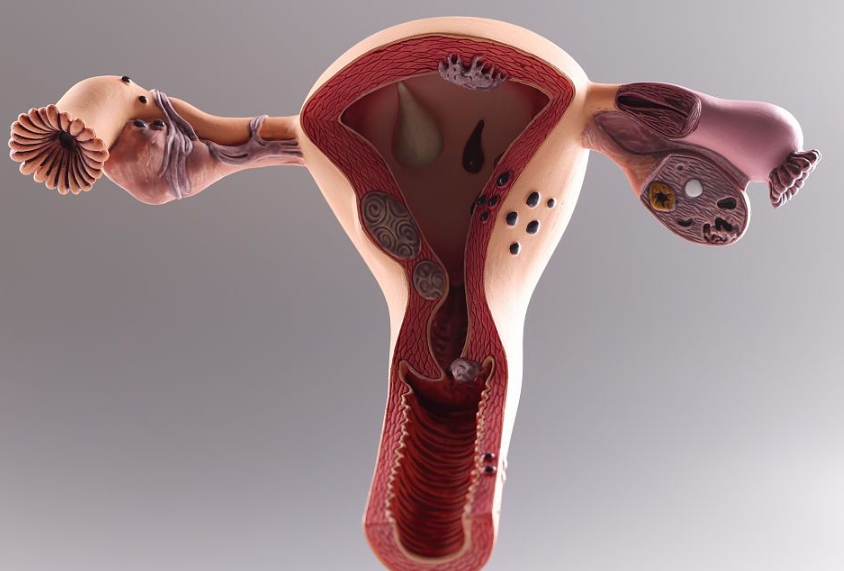 子宫内膜异位症