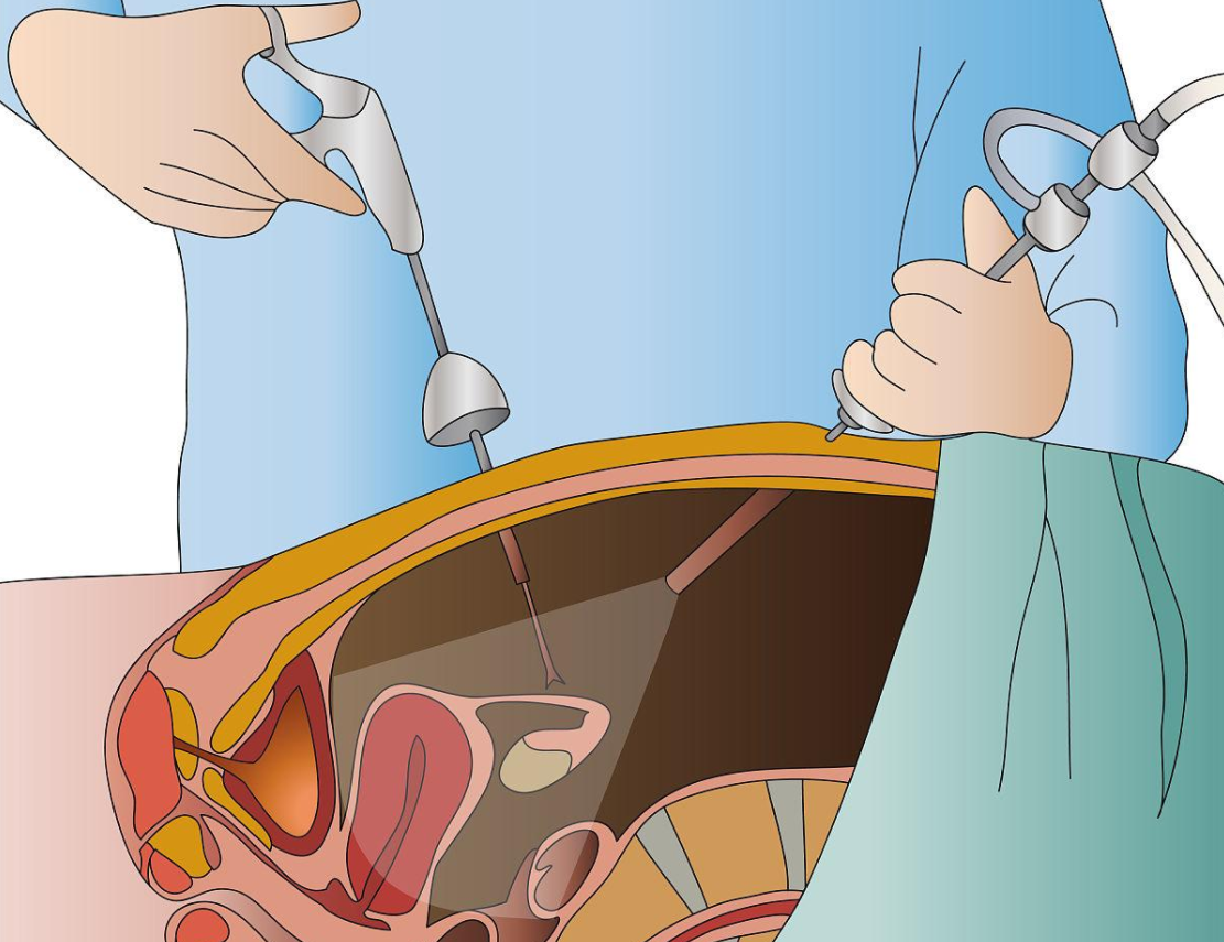 腹腔镜微创手术