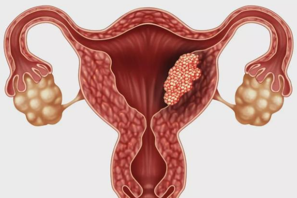 慢性子宫内膜炎