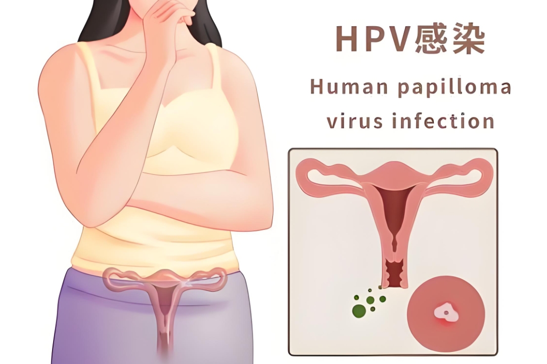 宫颈hpv感染