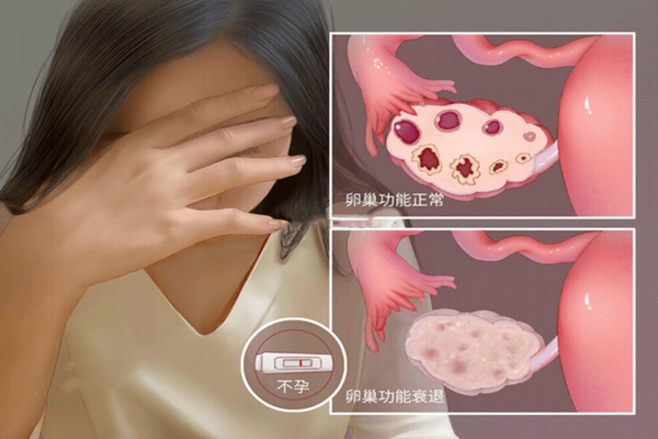 卵巢储备低下