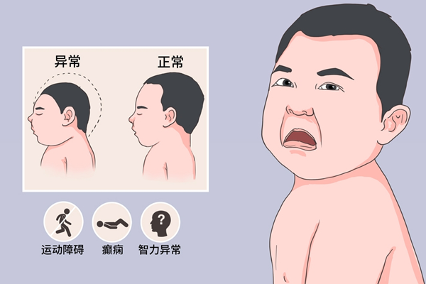 畸形儿