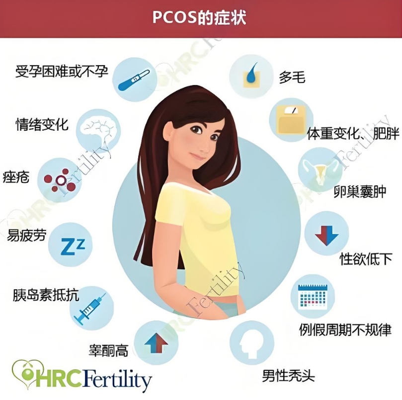 多囊卵巢综合征