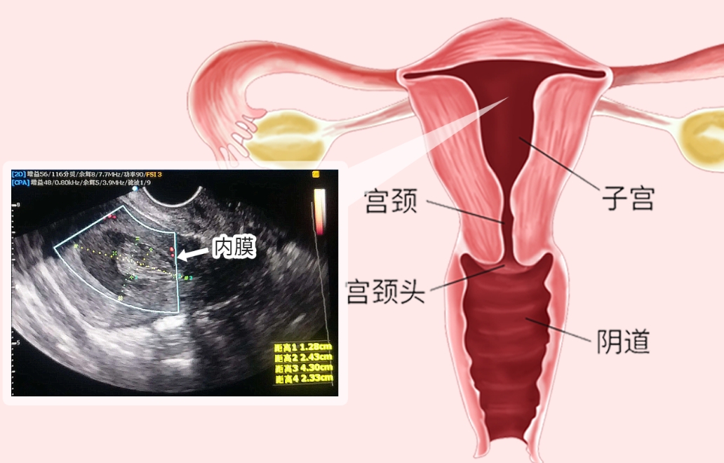 子宫内膜检查
