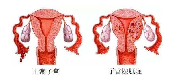 子宫腺肌症