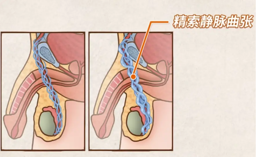 精索静脉曲张2.png