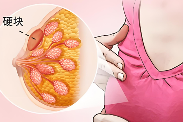 乳腺肿块