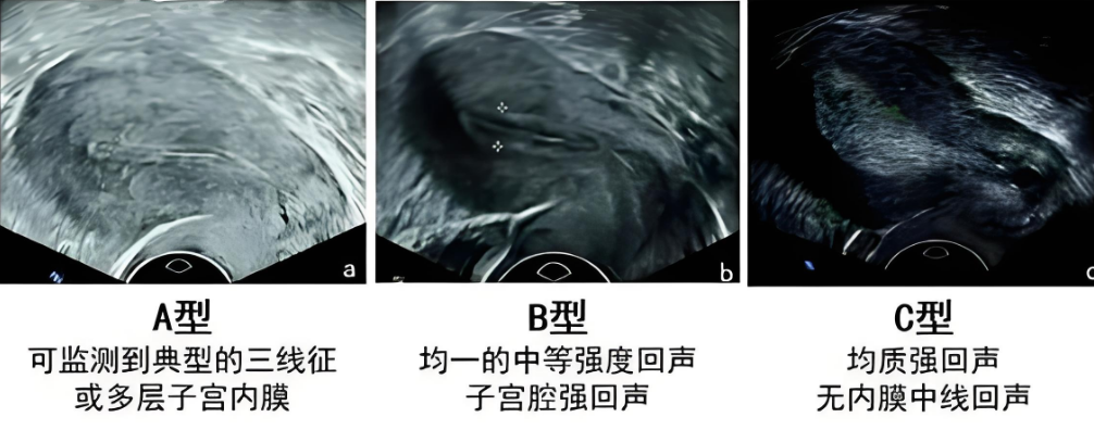 子宫内膜abc