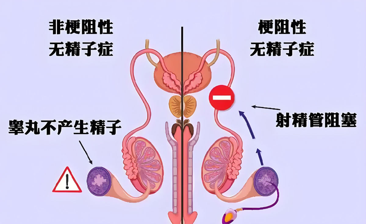 梗阻性无精症