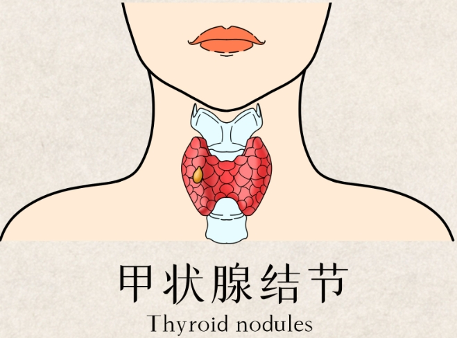 甲状腺结节