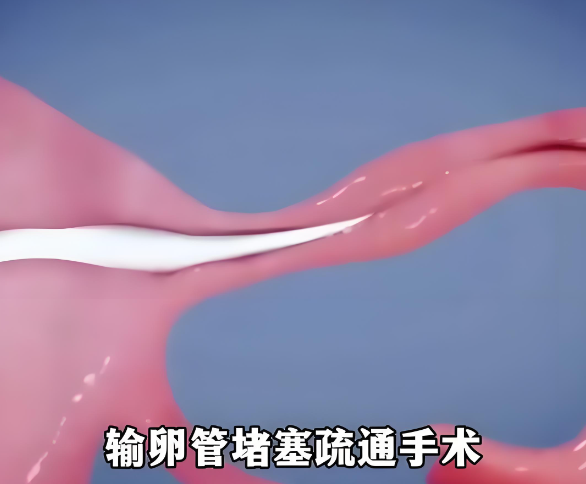 输卵管疏通手术