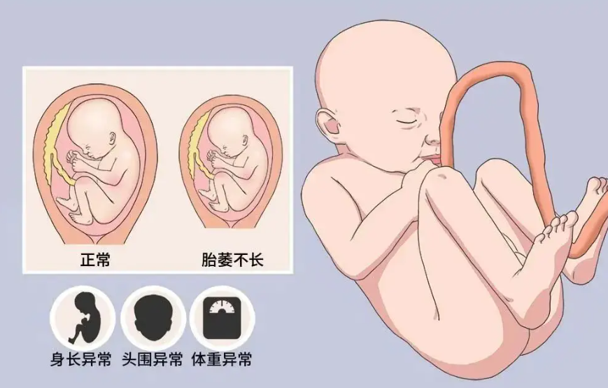 胎儿宫内发育迟缓