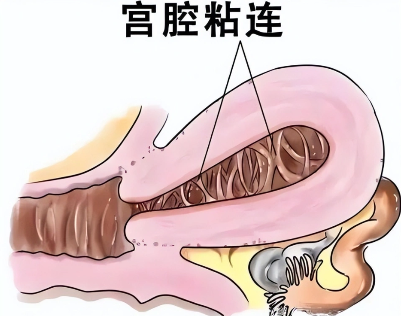 宫腔黏连